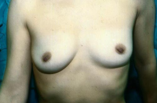 PATIENT WITH SMALL BREAST